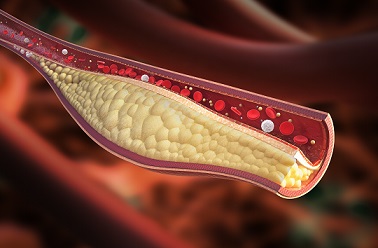 Illustration of stable atherosclerotic plaque.